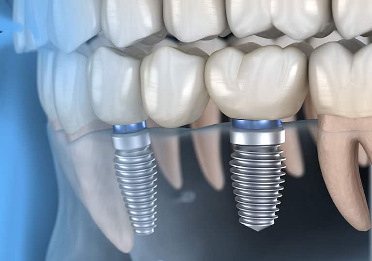 Cost of Dental Implants