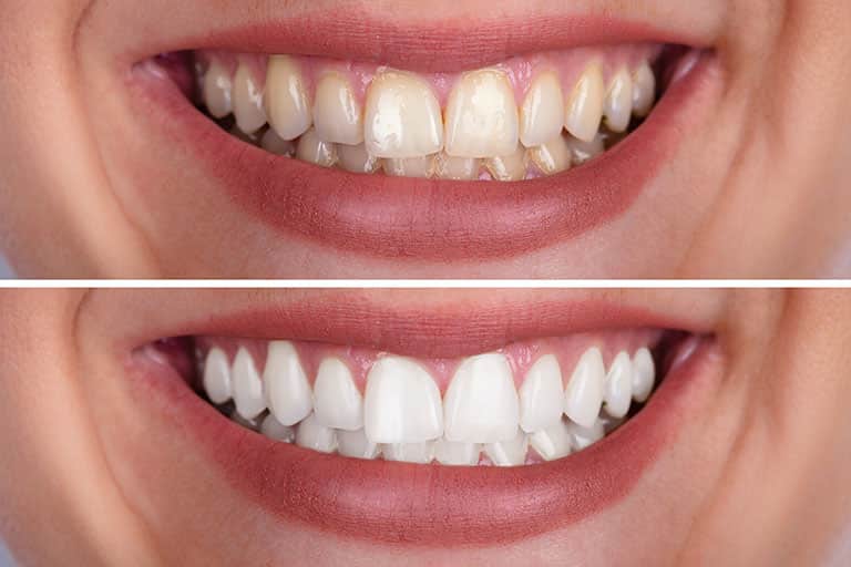 Tooth bonding on sale cost uk