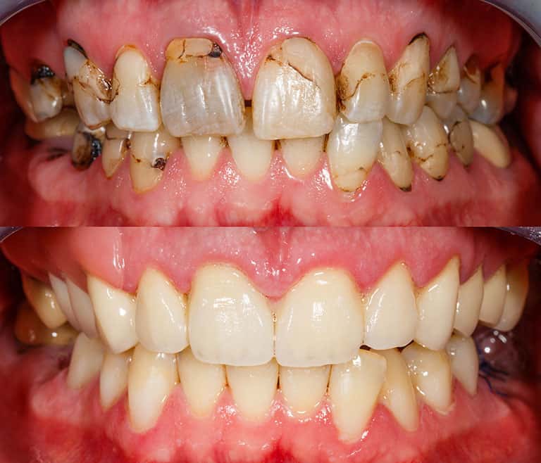 Composite bonding before and after 2 - Smile Works Dental