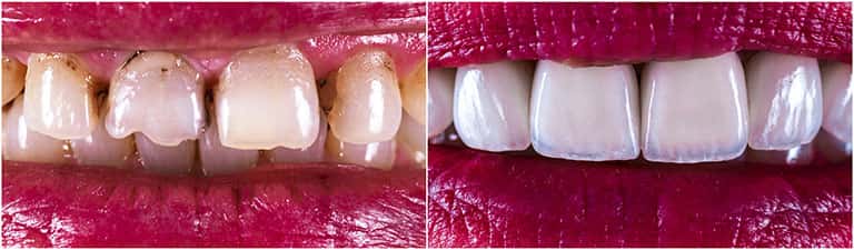 Change shape or size of your teeth by veneers - Smile Works Dental