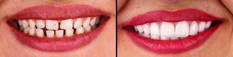 Improve teeth alignment by veneers - Smile Works Dental