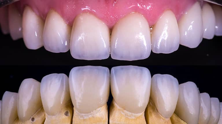 Dental veneers - Smile Works Dental