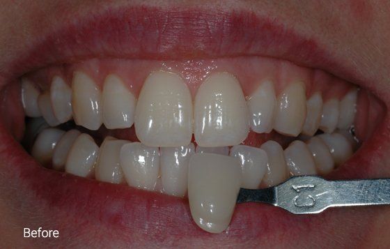 before teeth whitening 3