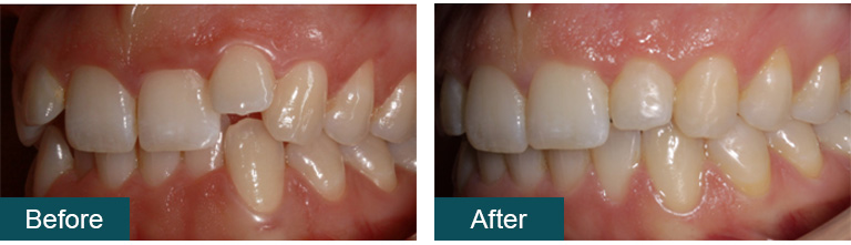 Invisalign before after1