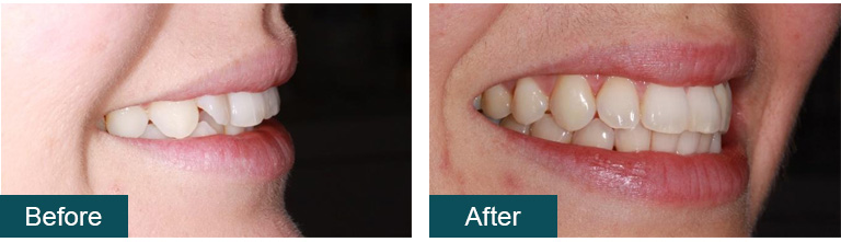 Invisalign Before and After 5 - Smile Works Dental