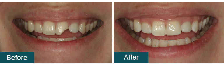Bonding Before After 1 - Smile Works Dental