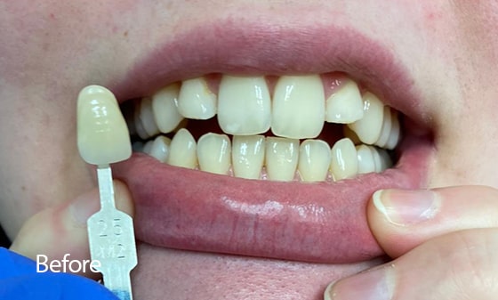 Teeth Whitening before 15