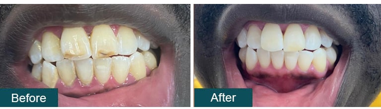 Teeth Whitening Before After 16 - Smile Works Dental