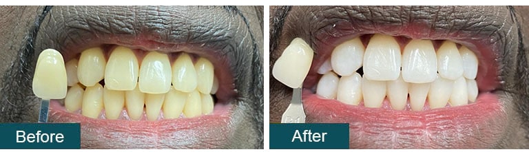 Teeth Whitening Before After 17 - Smile Works Dental