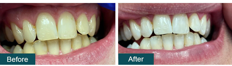 Teeth Whitening Before After 1 - Smile Works Dental