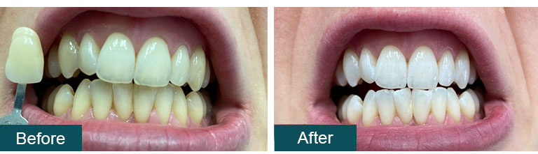 Teeth Whitening Before After 2 - Smile Works Dental
