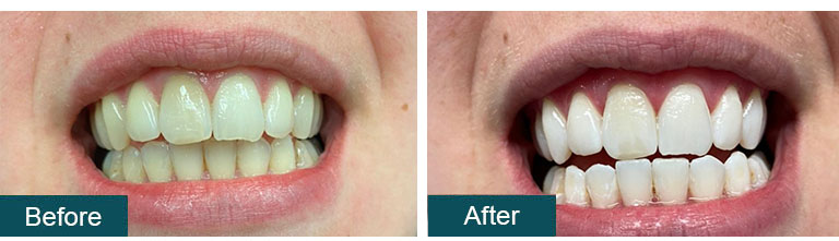 Smile Gallery (Before and After Images) - Smile Works Dental