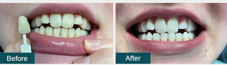 Teeth Whitening Before After 10 - Smile Works Dental
