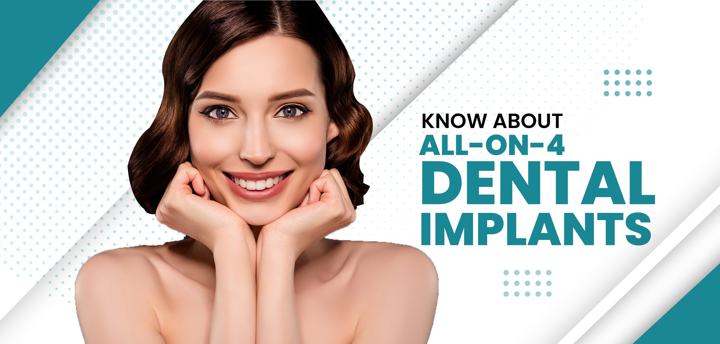 All You Should Know about All On 4 Dental Implants