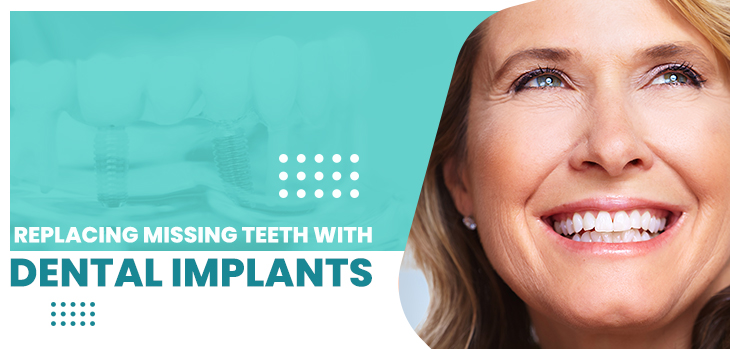 Steps for Replacing Missing Teeth with Dental Implants