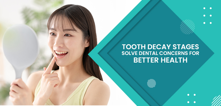 Tooth Decay Stages: Solve Dental Concerns for Better Health