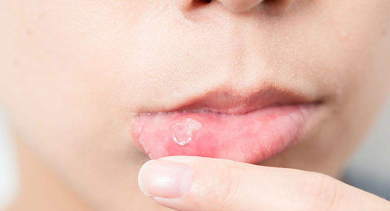 can you treat oral thrush with diflucan