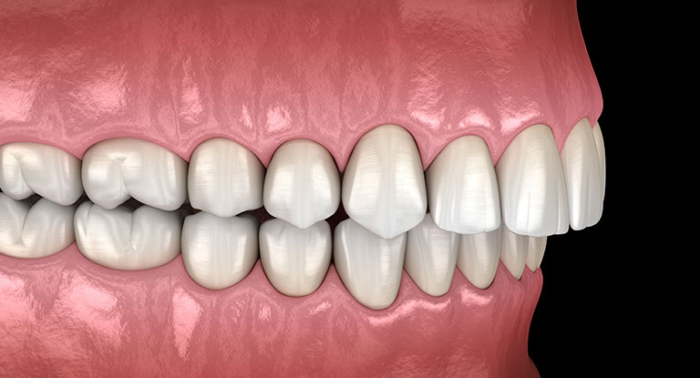 How to Fix an Overbite: Causes and Corrections - BDG