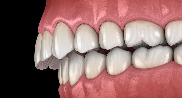 Overbite | Causes and Treatments | Smile Works Dental