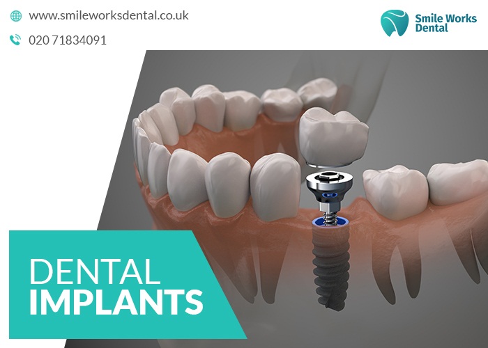 Dental Implants Harley Street - Tooth Implants from £995