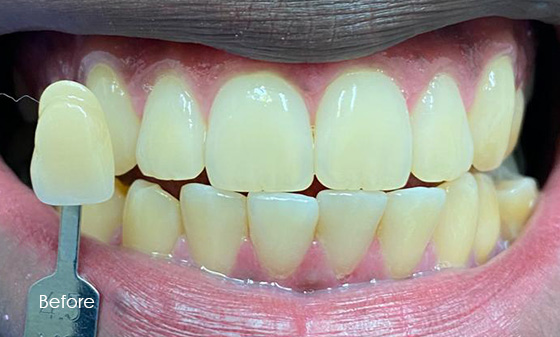 before teeth whitening 5