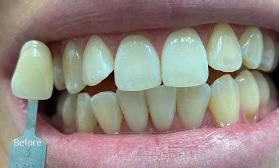 before teeth whitening 2