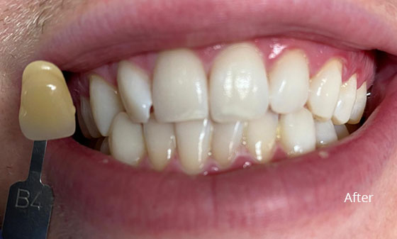 after teeth whitening 1