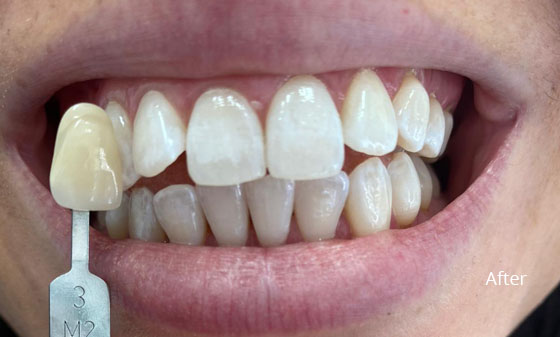 after teeth whitening 2